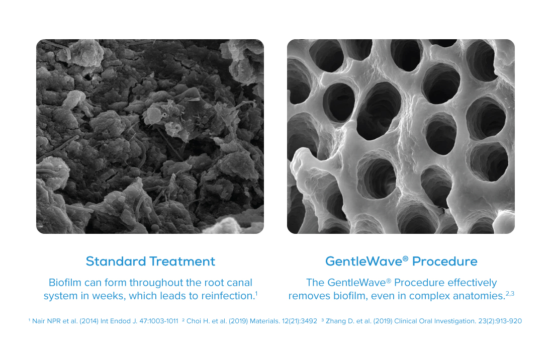 Steamboat Springs Endodontist with GentleWave biofilm