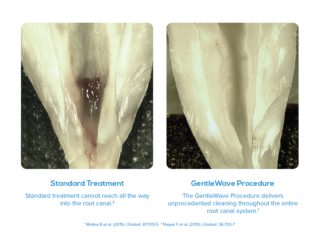 Steamboat Springs Endodontist with GentleWave cleaning